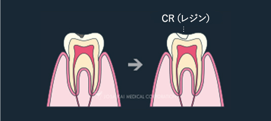 C1：エナメル質内の虫歯