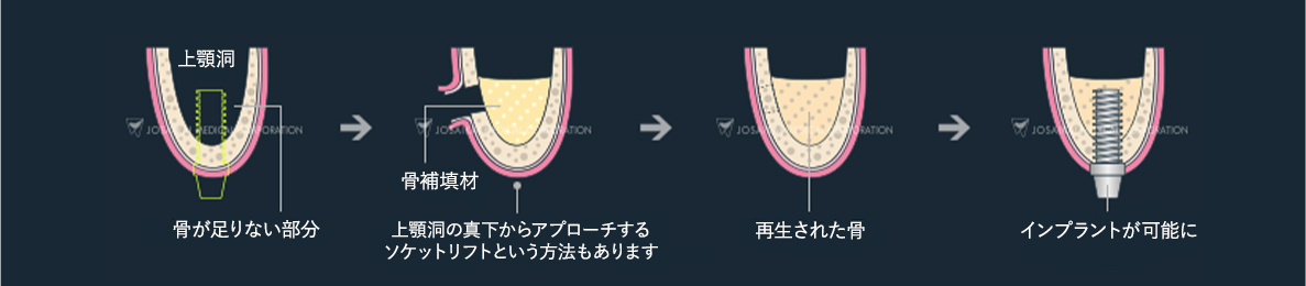 サイナスリフト