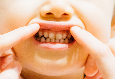 乳歯は虫歯になりやすく、進行しやすい