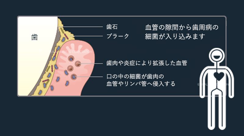 歯周病と全身との関わり