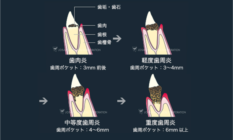 歯周病の進行と分類