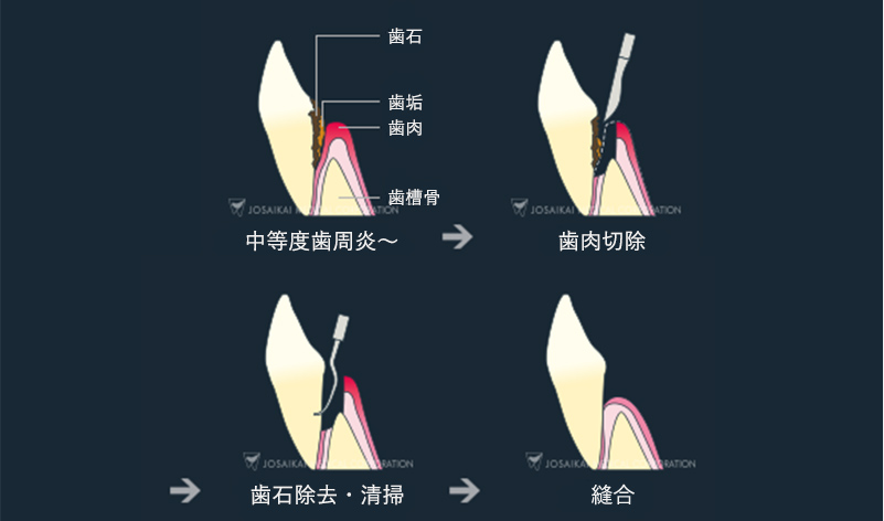 フラップ手術