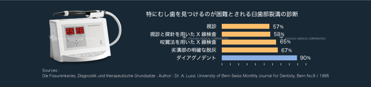 レーザ光を使用したむし歯の診断装置「ダイアグノデント」