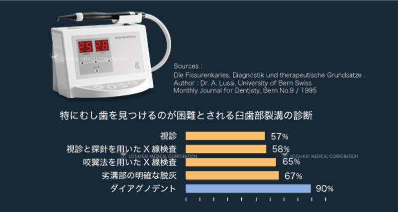 レーザ光を使用したむし歯の診断装置「ダイアグノデント」